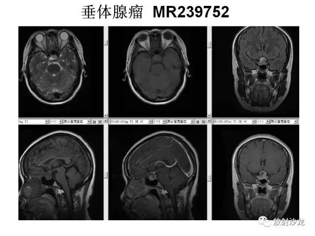 【PPT】垂体瘤的MR诊断与鉴别诊断