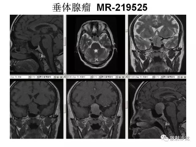 【PPT】垂体瘤的MR诊断与鉴别诊断