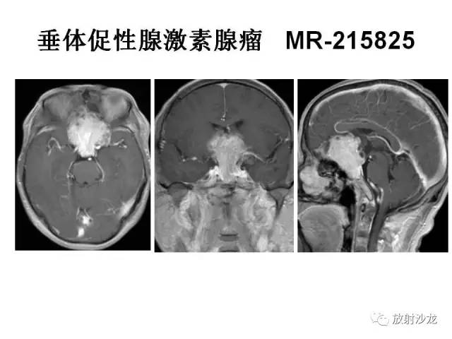 【PPT】垂体瘤的MR诊断与鉴别诊断