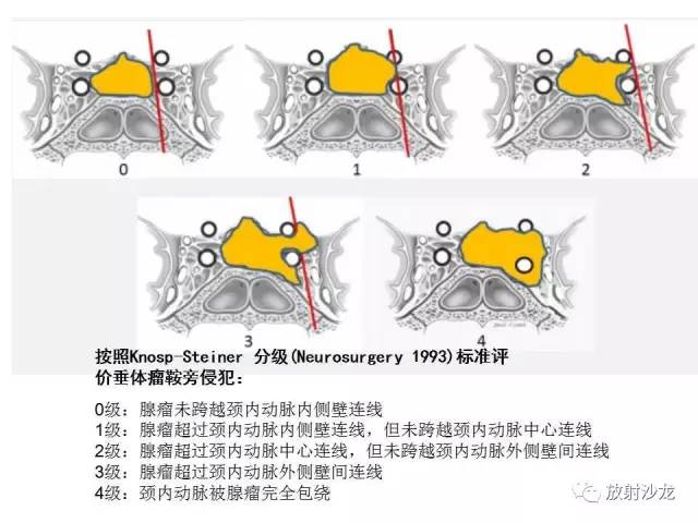 【PPT】垂体瘤的MR诊断与鉴别诊断