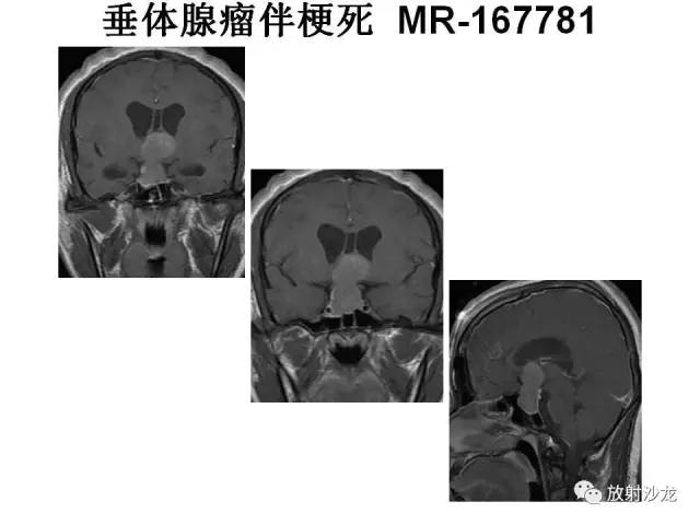 【PPT】垂体瘤的MR诊断与鉴别诊断