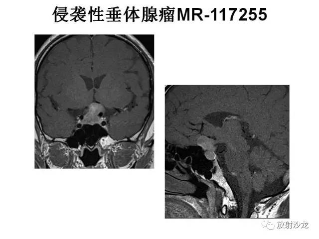 【PPT】垂体瘤的MR诊断与鉴别诊断