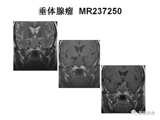 【PPT】垂体瘤的MR诊断与鉴别诊断