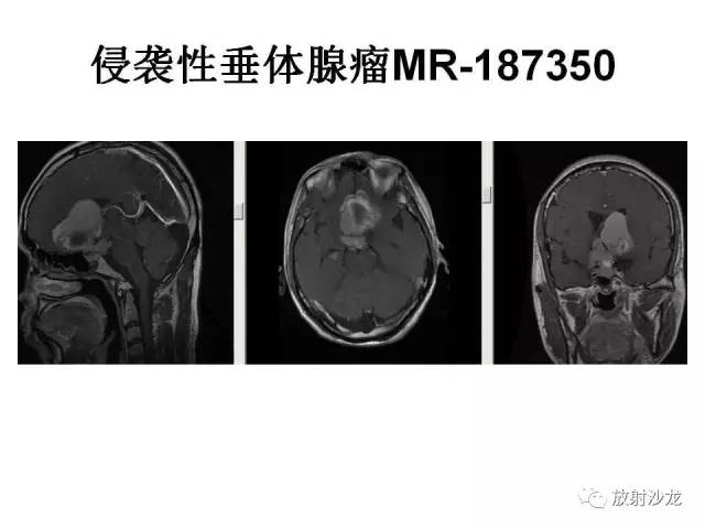 【PPT】垂体瘤的MR诊断与鉴别诊断