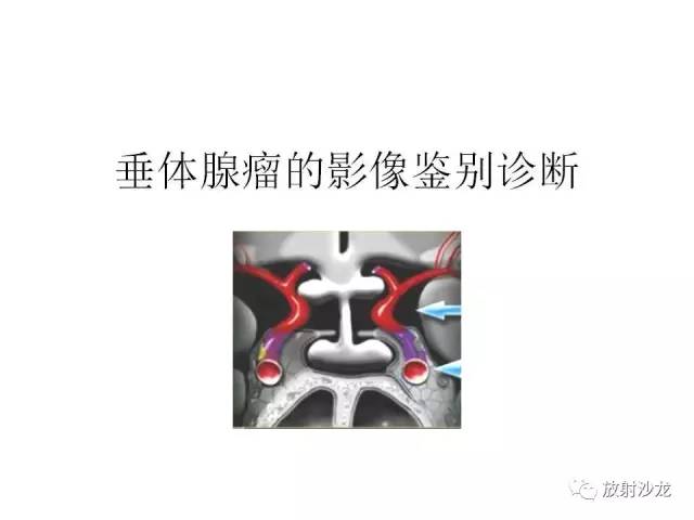 【PPT】垂体瘤的MR诊断与鉴别诊断