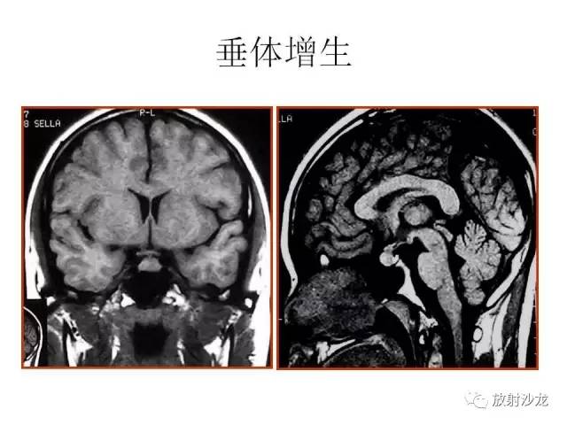 【PPT】垂体瘤的MR诊断与鉴别诊断