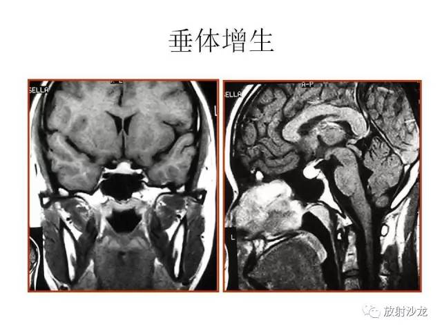 【PPT】垂体瘤的MR诊断与鉴别诊断