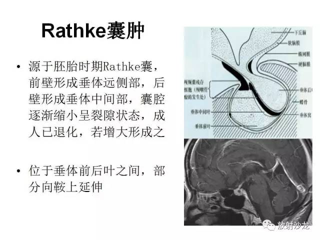 【PPT】垂体瘤的MR诊断与鉴别诊断