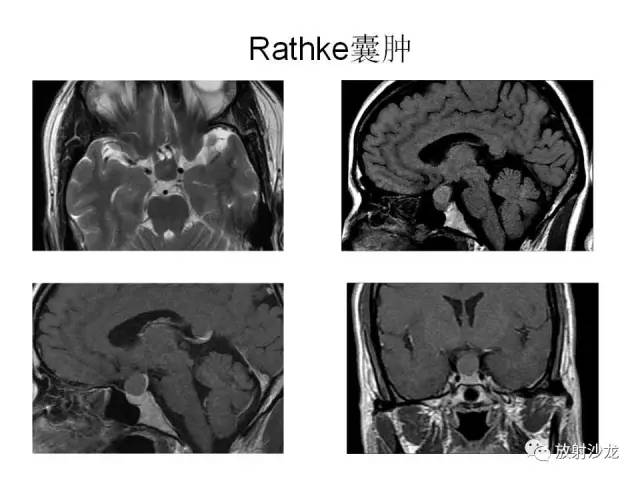 【PPT】垂体瘤的MR诊断与鉴别诊断