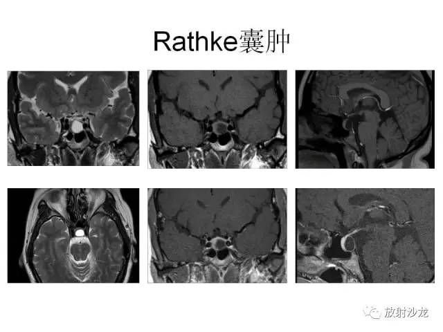 【PPT】垂体瘤的MR诊断与鉴别诊断