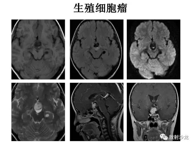 【PPT】垂体瘤的MR诊断与鉴别诊断