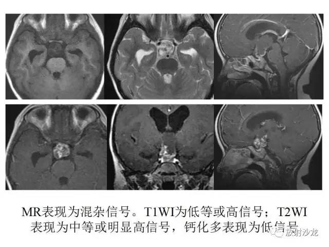 【PPT】垂体瘤的MR诊断与鉴别诊断