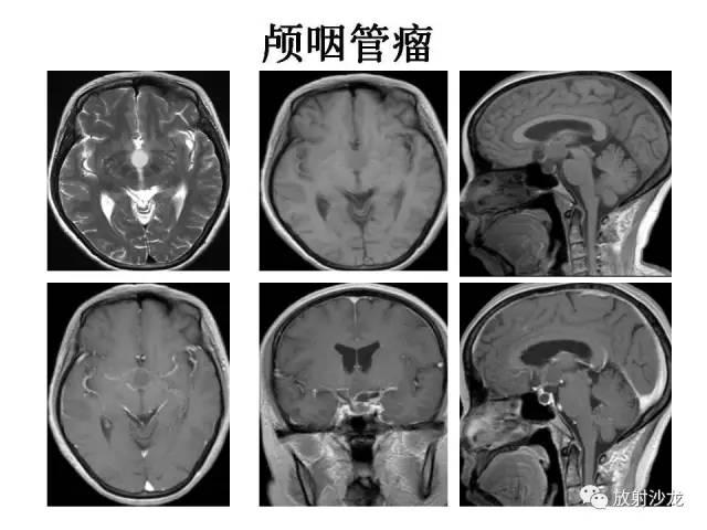【PPT】垂体瘤的MR诊断与鉴别诊断