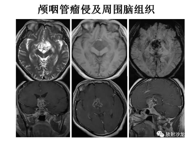 【PPT】垂体瘤的MR诊断与鉴别诊断