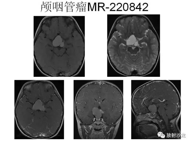 【PPT】垂体瘤的MR诊断与鉴别诊断
