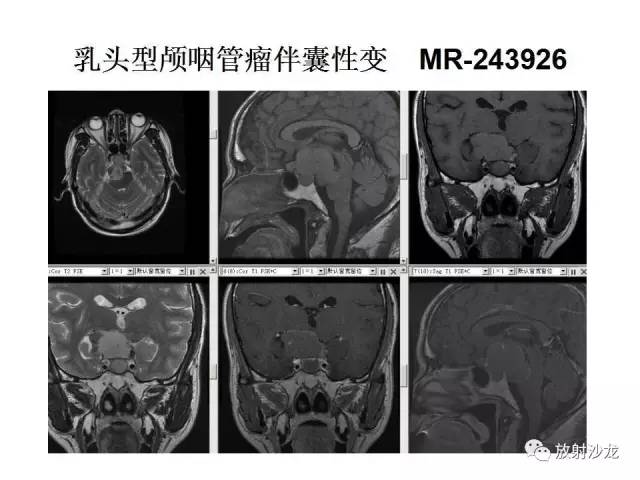 【PPT】垂体瘤的MR诊断与鉴别诊断