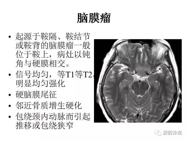 【PPT】垂体瘤的MR诊断与鉴别诊断