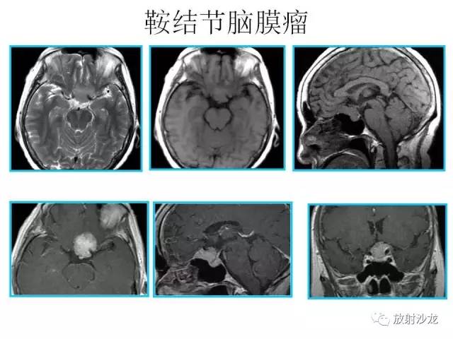 【PPT】垂体瘤的MR诊断与鉴别诊断