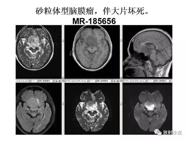 【PPT】垂体瘤的MR诊断与鉴别诊断