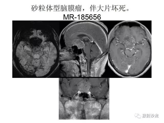 【PPT】垂体瘤的MR诊断与鉴别诊断