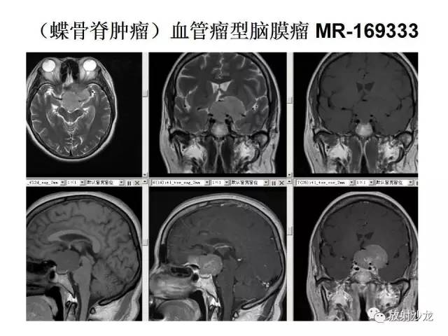 【PPT】垂体瘤的MR诊断与鉴别诊断