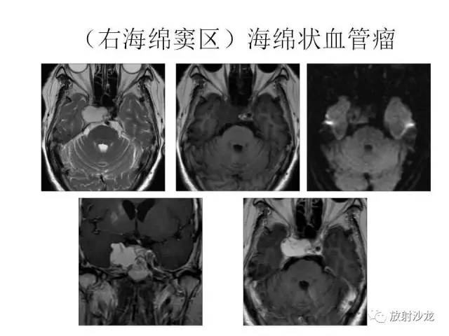 【PPT】垂体瘤的MR诊断与鉴别诊断