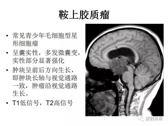 【PPT】垂体瘤的MR诊断与鉴别诊断