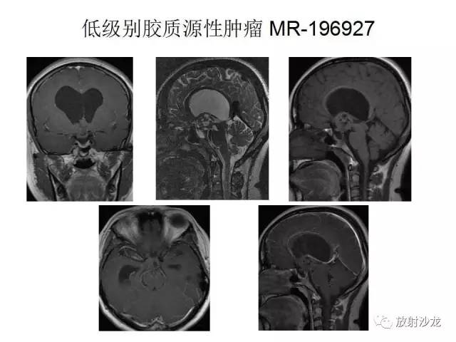 【PPT】垂体瘤的MR诊断与鉴别诊断