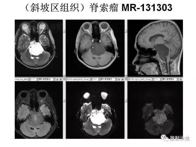 【PPT】垂体瘤的MR诊断与鉴别诊断