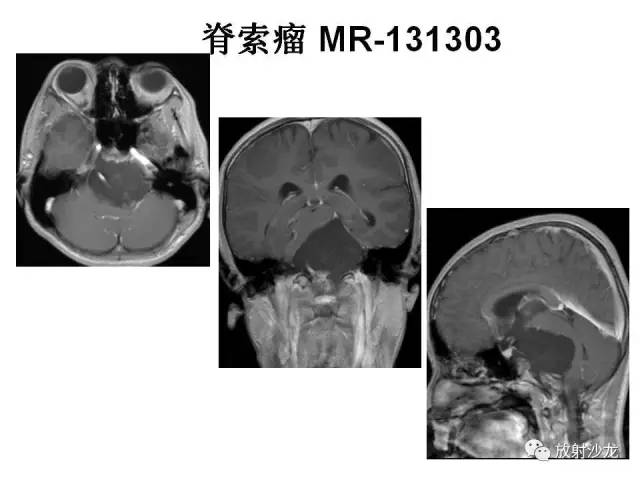 【PPT】垂体瘤的MR诊断与鉴别诊断