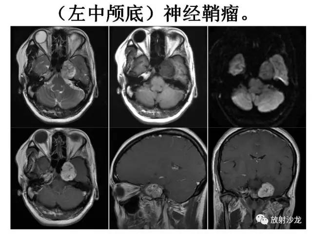 【PPT】垂体瘤的MR诊断与鉴别诊断