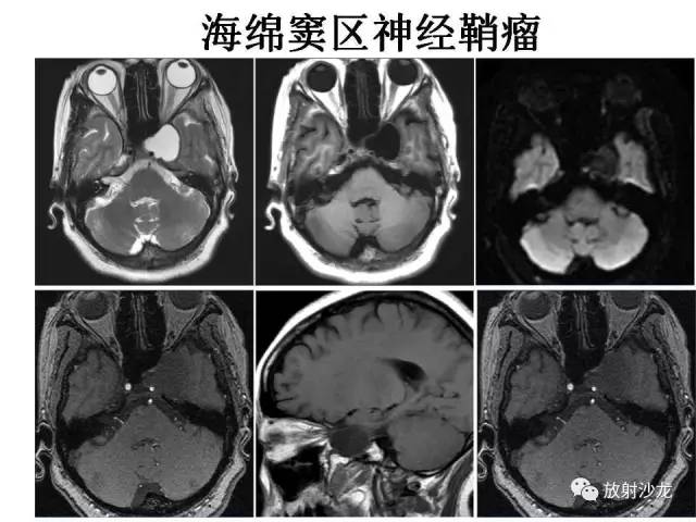 【PPT】垂体瘤的MR诊断与鉴别诊断