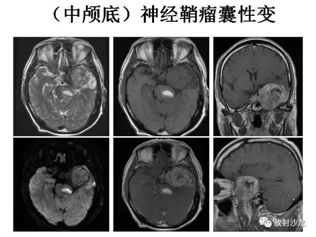 【PPT】垂体瘤的MR诊断与鉴别诊断