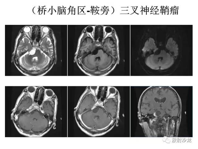 【PPT】垂体瘤的MR诊断与鉴别诊断