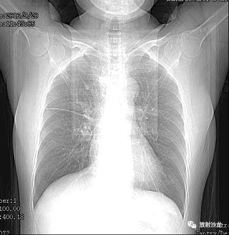 额外肺叶——奇叶 额外肺叶——奇叶