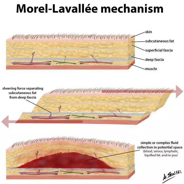 Morel-Lavallée 损伤的影像表现
