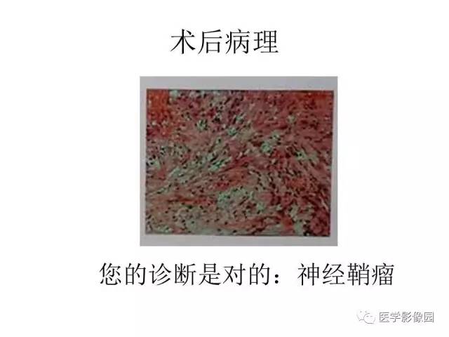 【病例】跨椎管占位——神经鞘瘤1例CT及MR