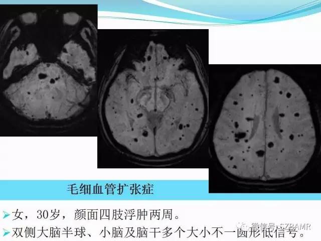 头颅SWI成像病例展示