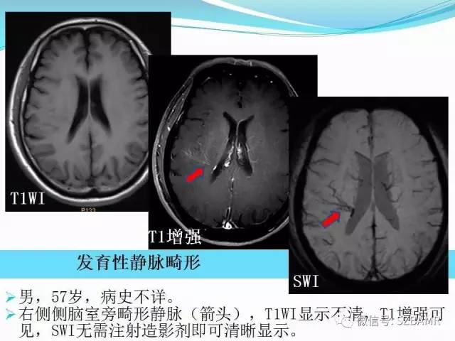 头颅SWI成像病例展示 头颅SWI成像病例展示