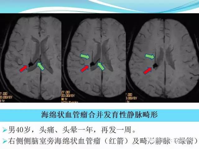 头颅SWI成像病例展示 头颅SWI成像病例展示