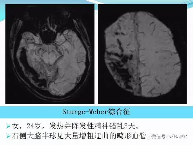 头颅SWI成像病例展示 头颅SWI成像病例展示