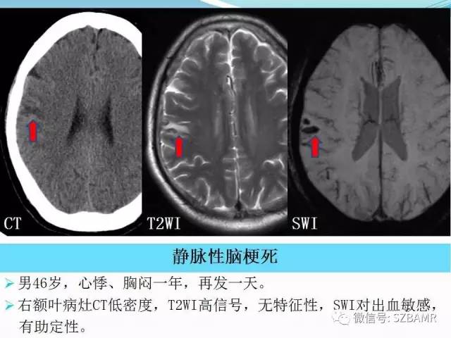 头颅SWI成像病例展示 头颅SWI成像病例展示