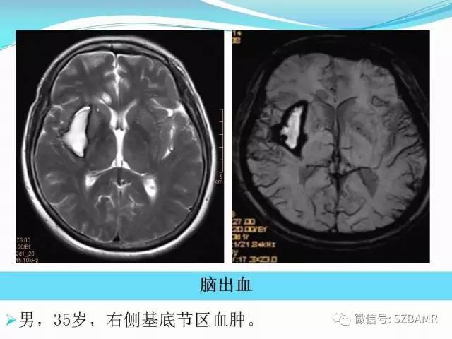 头颅SWI成像病例展示 头颅SWI成像病例展示