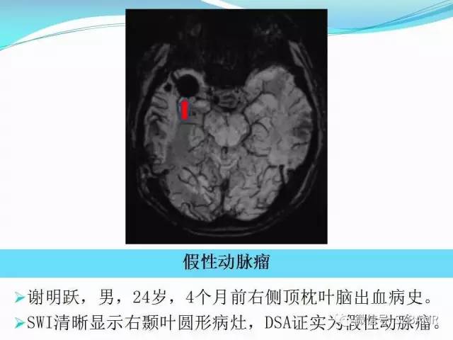 头颅SWI成像病例展示 头颅SWI成像病例展示