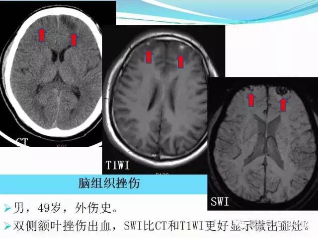 头颅SWI成像病例展示 头颅SWI成像病例展示