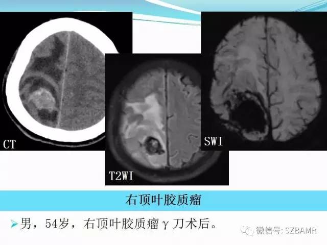 头颅SWI成像病例展示 头颅SWI成像病例展示