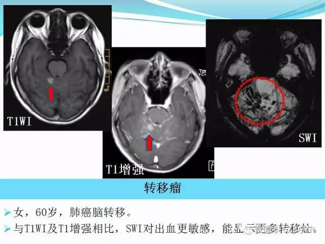 头颅SWI成像病例展示 头颅SWI成像病例展示