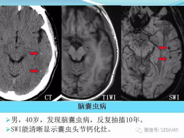 头颅SWI成像病例展示 头颅SWI成像病例展示