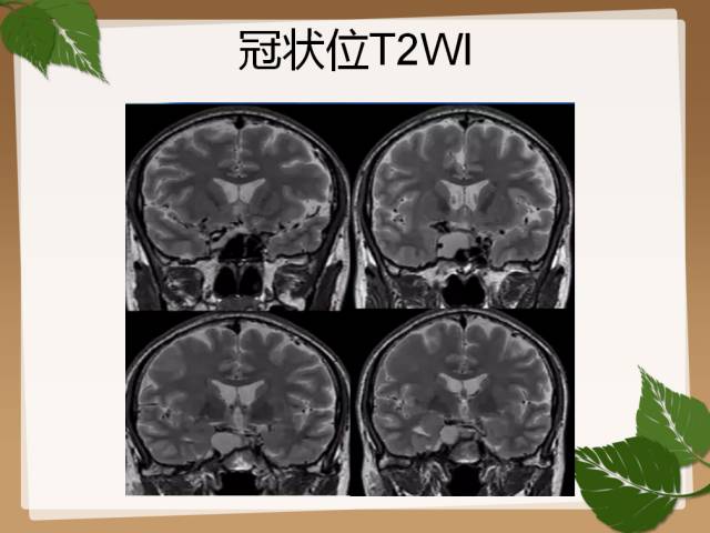 【PPT】鞍旁病例分析