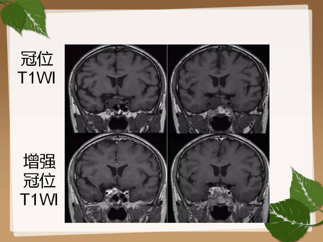 【PPT】鞍旁病例分析